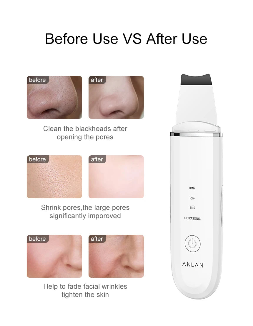 ANLAN Ultrasonic Skin Scrubber – Deep Facial Cleansing & EMS Lifting Tool