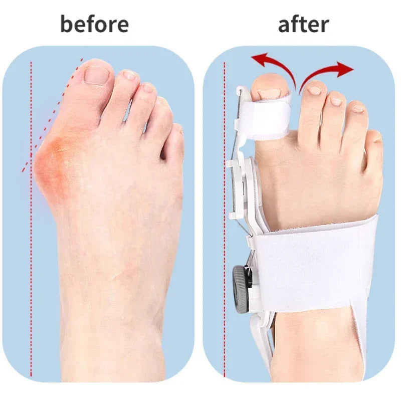 Adjustable Bunion Corrector Brace – Toe Separator and Hallux Valgus Straightener